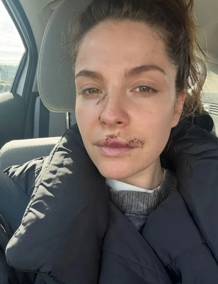 Skådespelerskan Paige Spara visar upp läkta ärr efter allvarligt hundbett